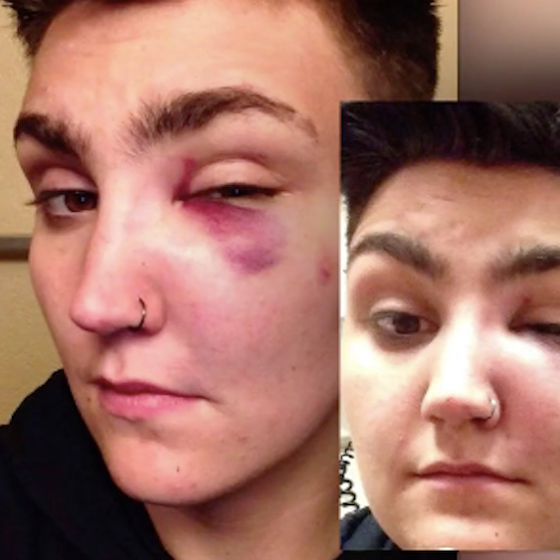 Several men attacked this trans guy in front of his home for “acting gay”
