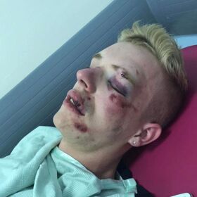 Attacker gets off easy for brutal, disfiguring beating of a gay man