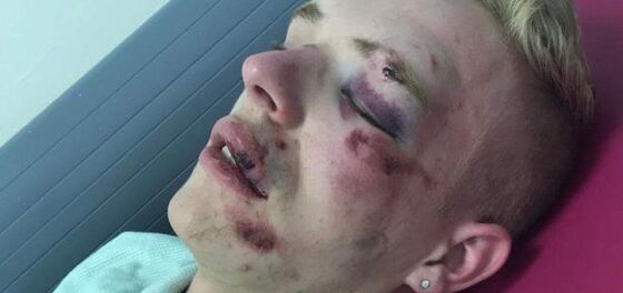 Attacker gets off easy for brutal, disfiguring beating of a gay man