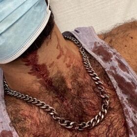 Another brutal attack in Spain leaves a gay man with a smashed jaw