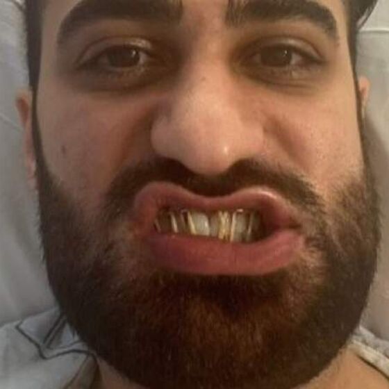 Doctor has jaw wired shut after violent antigay attack outside NYC subway station